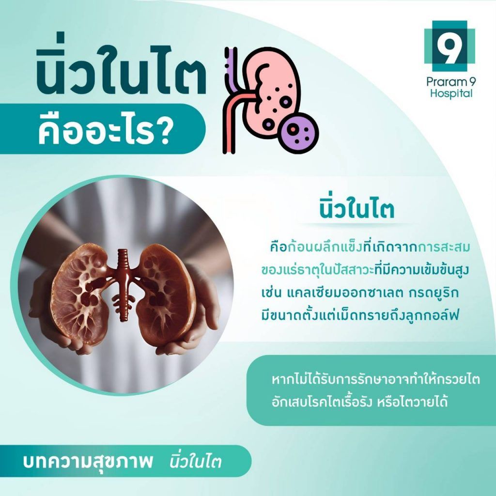 นิ่วในไตคืออะไร-1024x1024.jpg