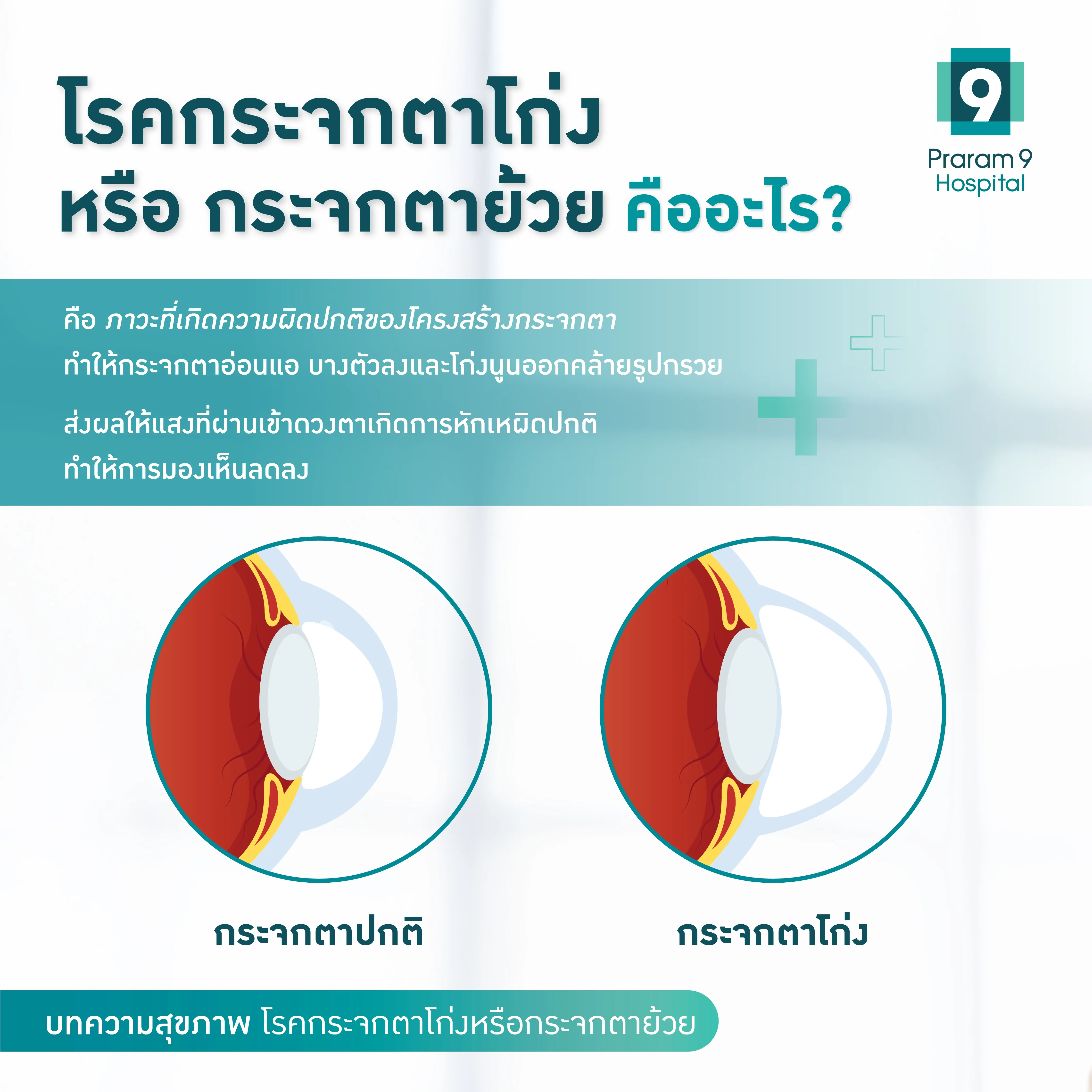 โรคกระจกตาโก่งหรือกระจกตาย้วย-Keratoconus-Infographic-1.webp