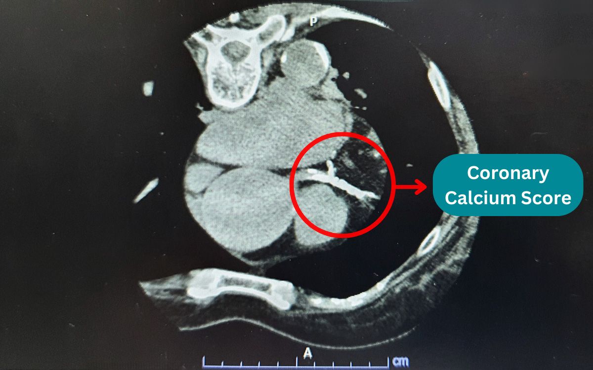 PR9-Calcified-Plaque-in-the-Coronary-Arteries-1.jpg