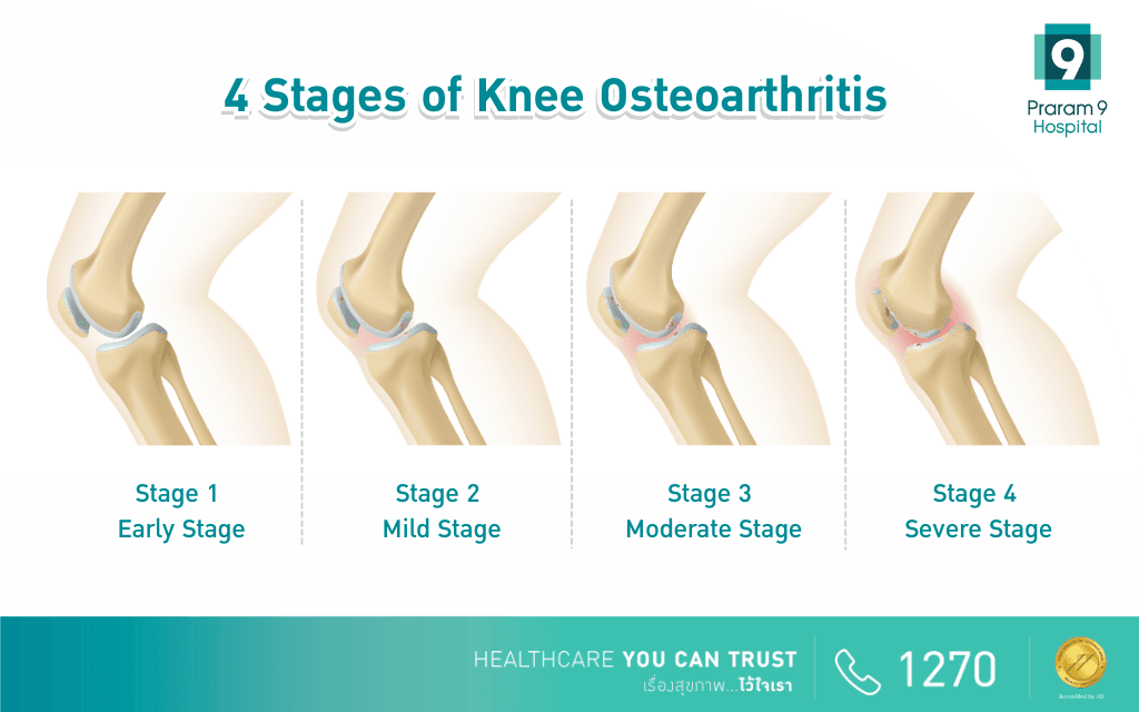 Stages-of-Knee-Osteoarthritis-PR9.png