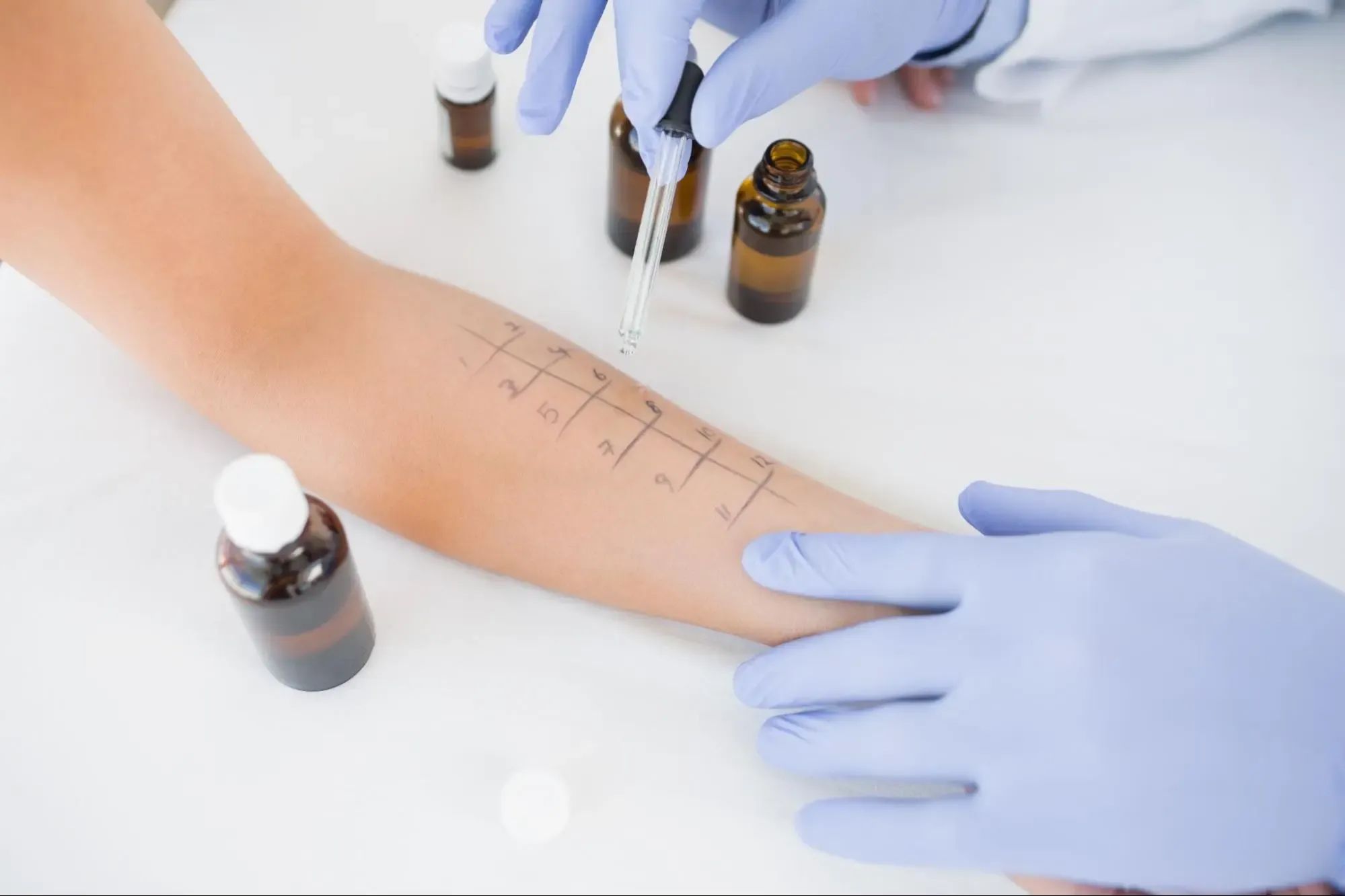 ทดสอบภูมิแพ้