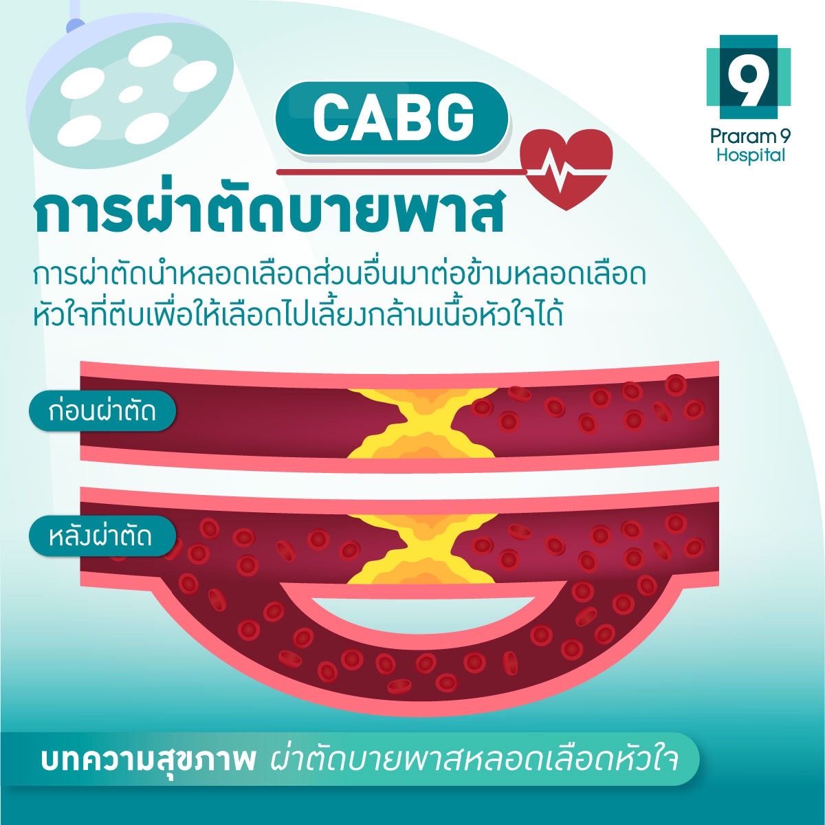 cabg-1.jpg