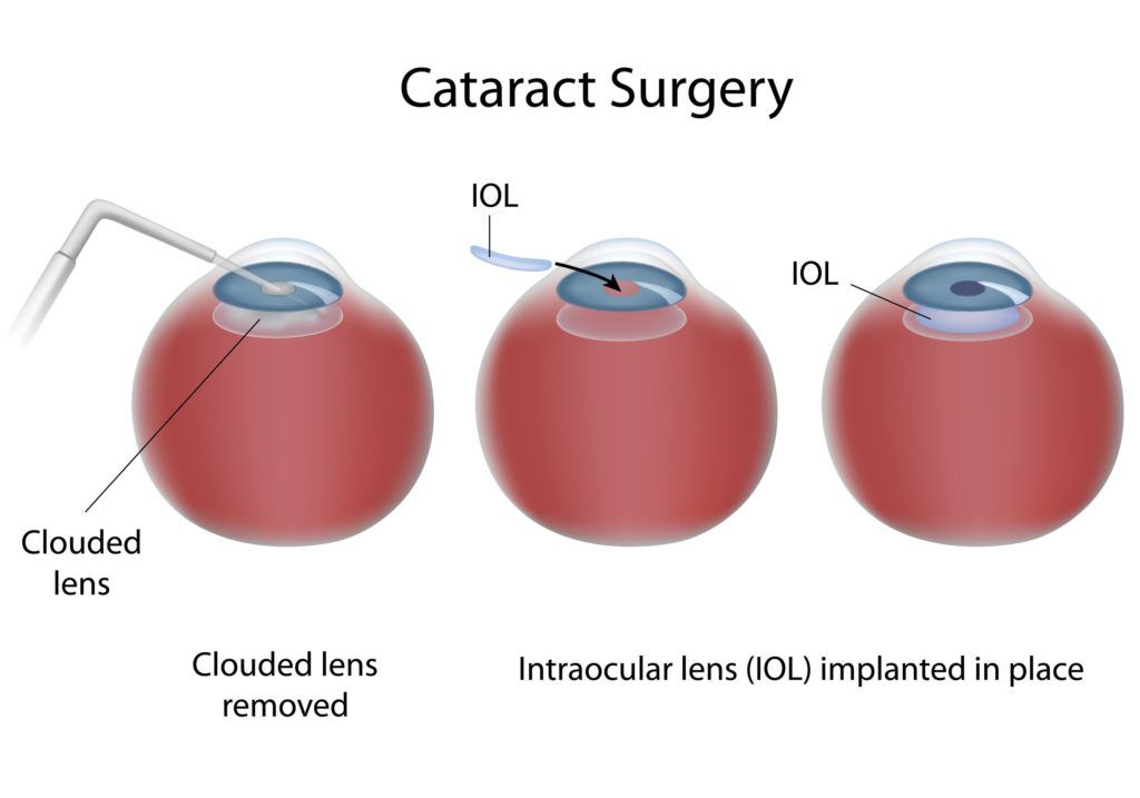 cataract-surgery-1.jpg