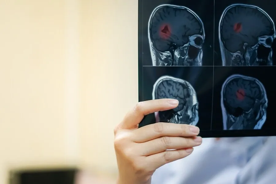 causes-of-brain-tumor.webp