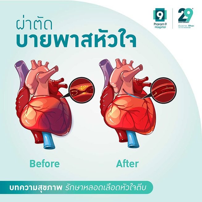 coronary-artery-bypass-grafting-2.jpg