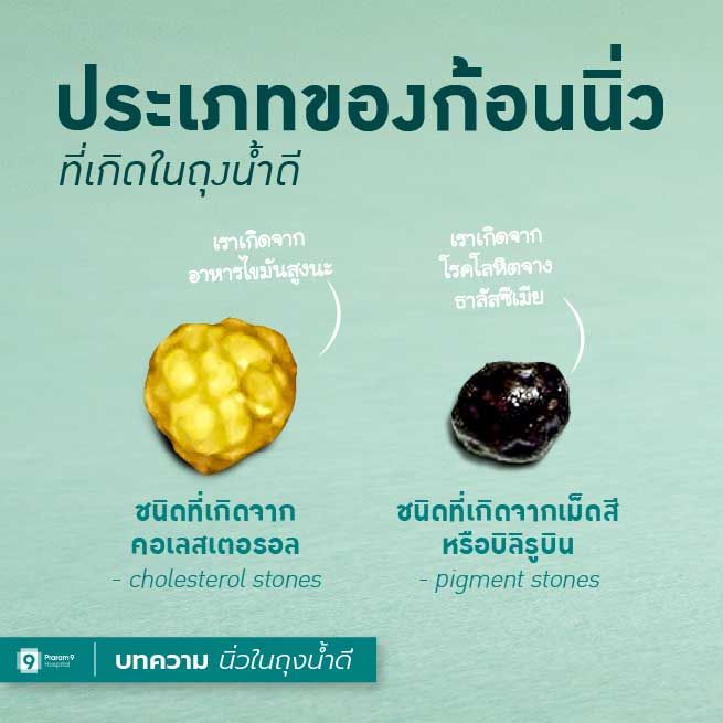 gallstone-4.jpg