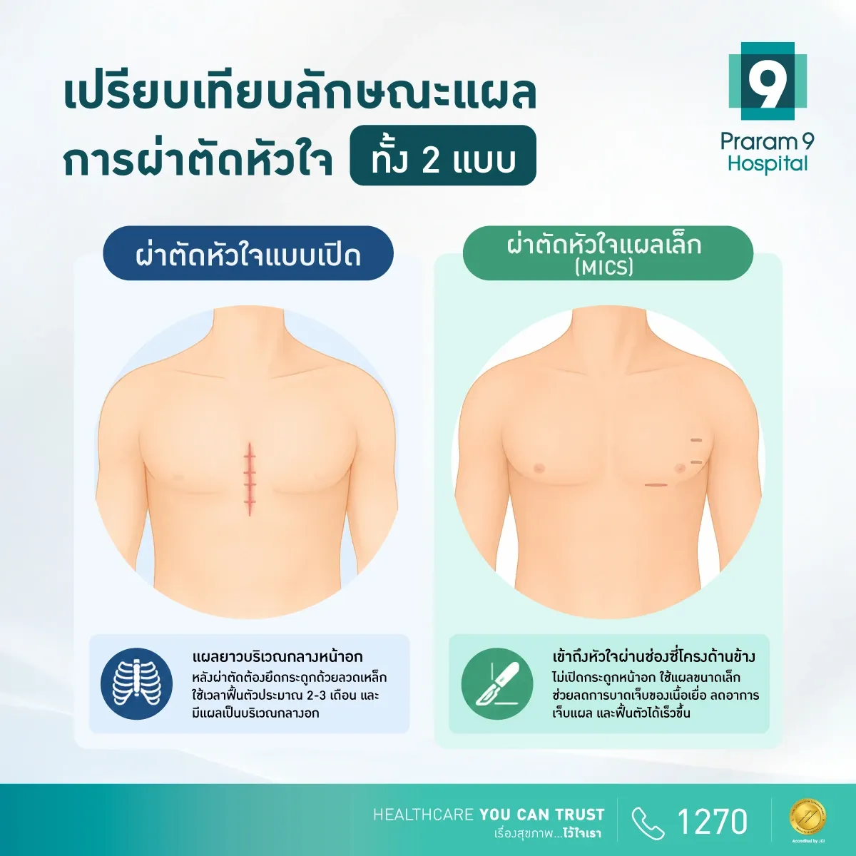 เปรียบเทียบลักษณะแผลการผ่าตัดหัวใจแบบเปิดกับผ่าตัดหัวใจแผลเล็ก (MICS)