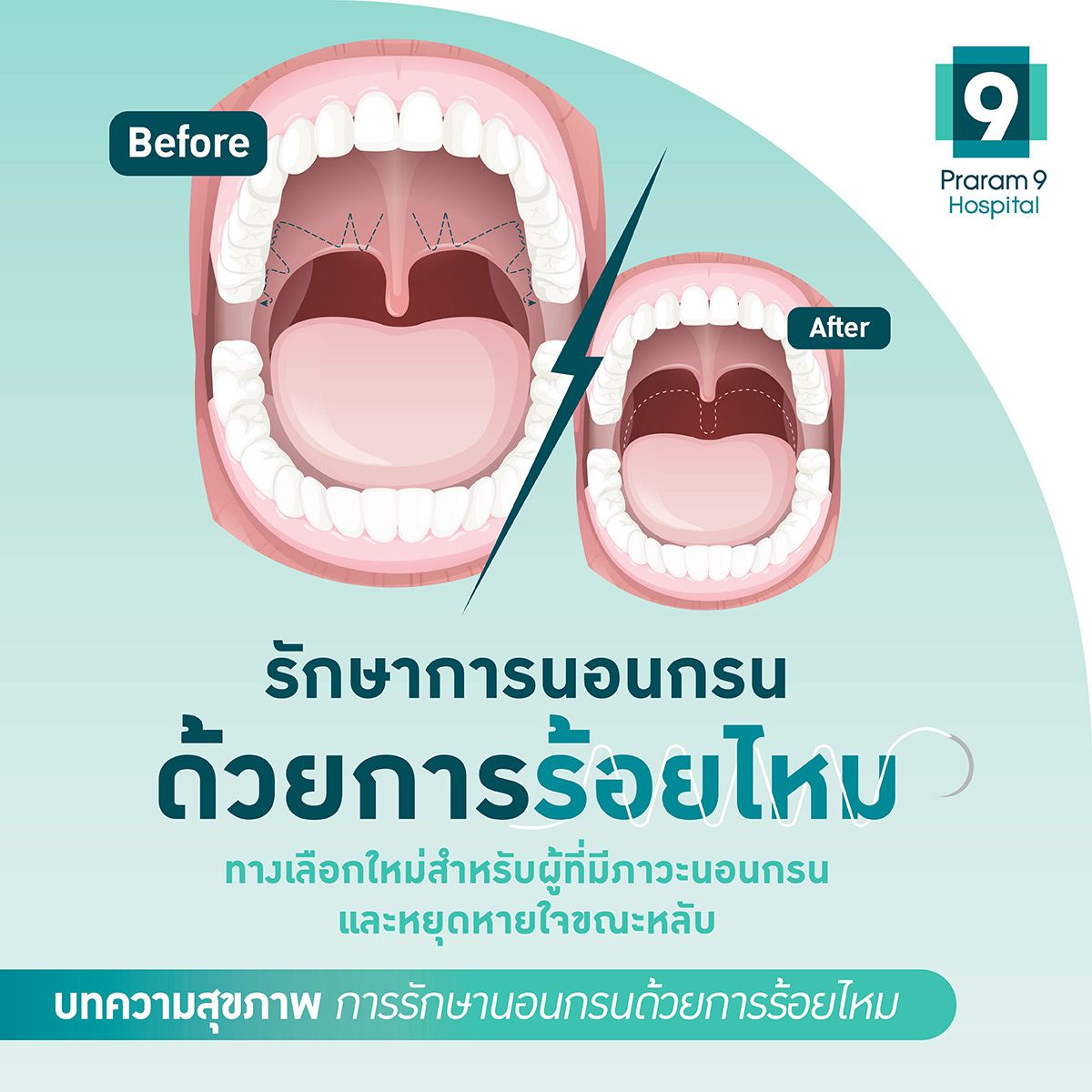 sling-snoreplasty-3.jpg