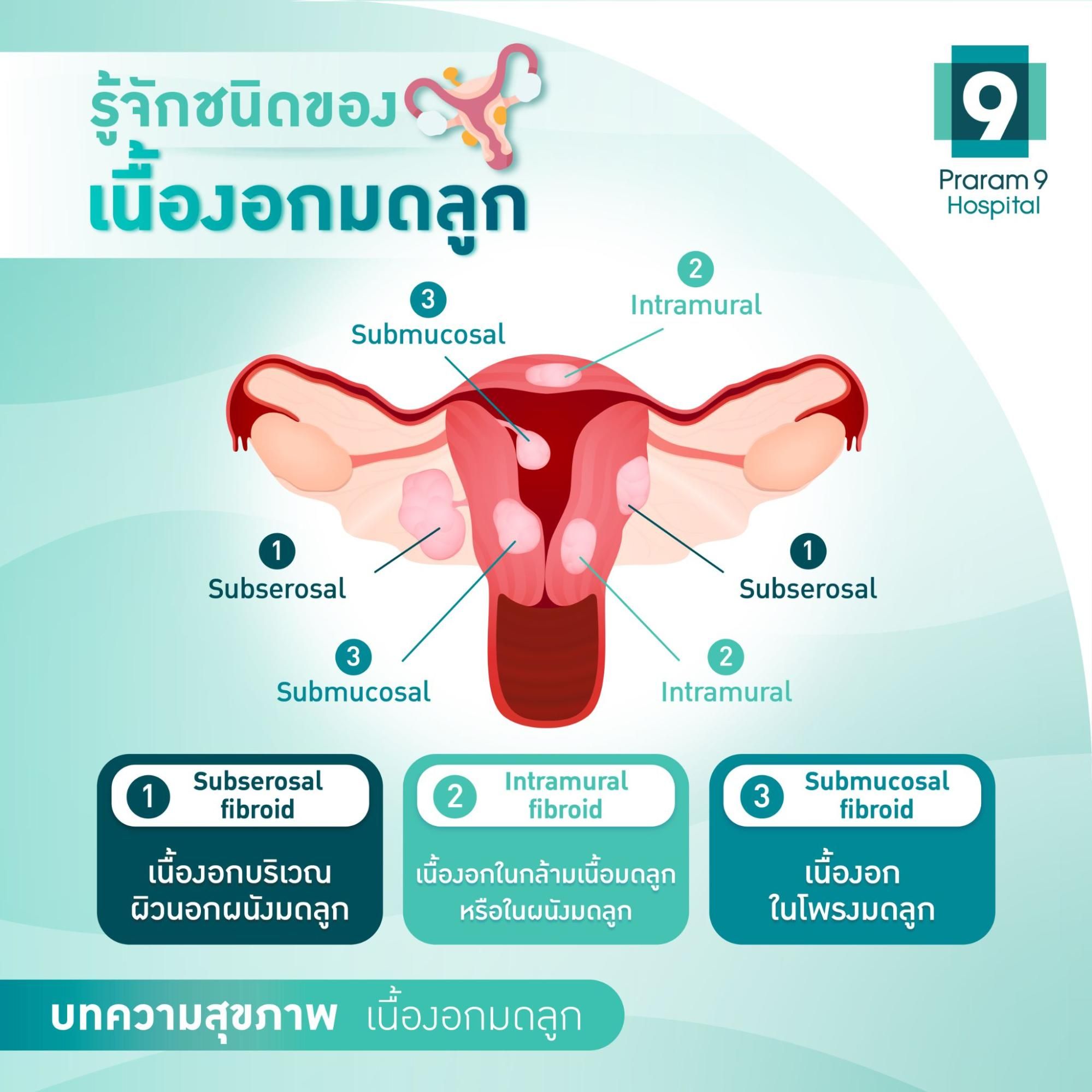 ชนิดเนื้องอกมดลูก